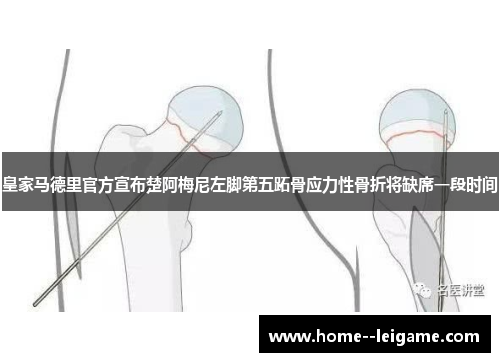 皇家马德里官方宣布楚阿梅尼左脚第五跖骨应力性骨折将缺席一段时间
